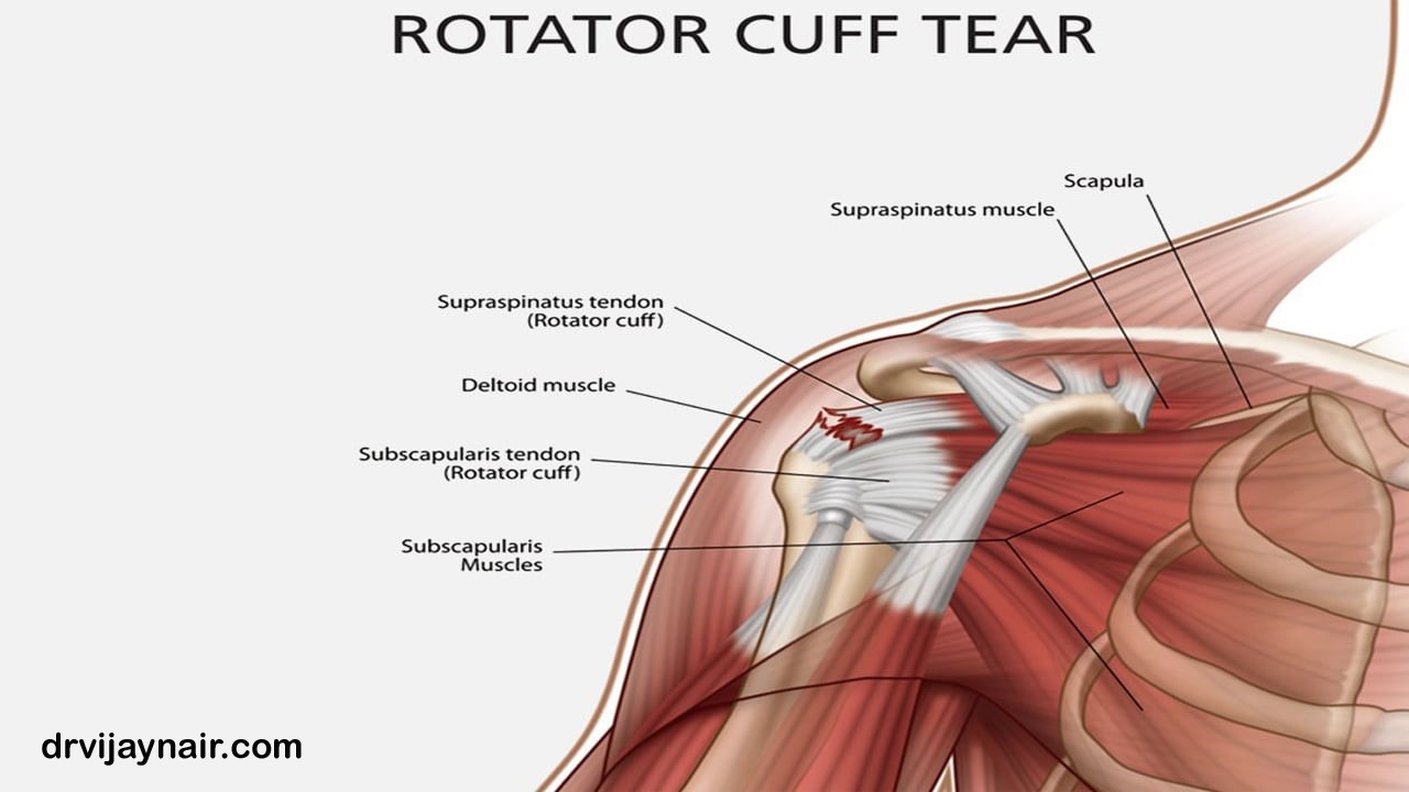 Rotator Cuff Injury Causes Diagnosis And Treatment Bangalore