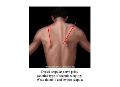 Dorsal Scapular Nerve Palsy