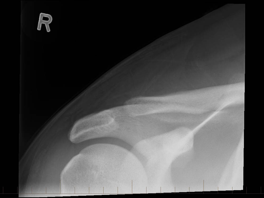 Distal Clavicle Osteolysis