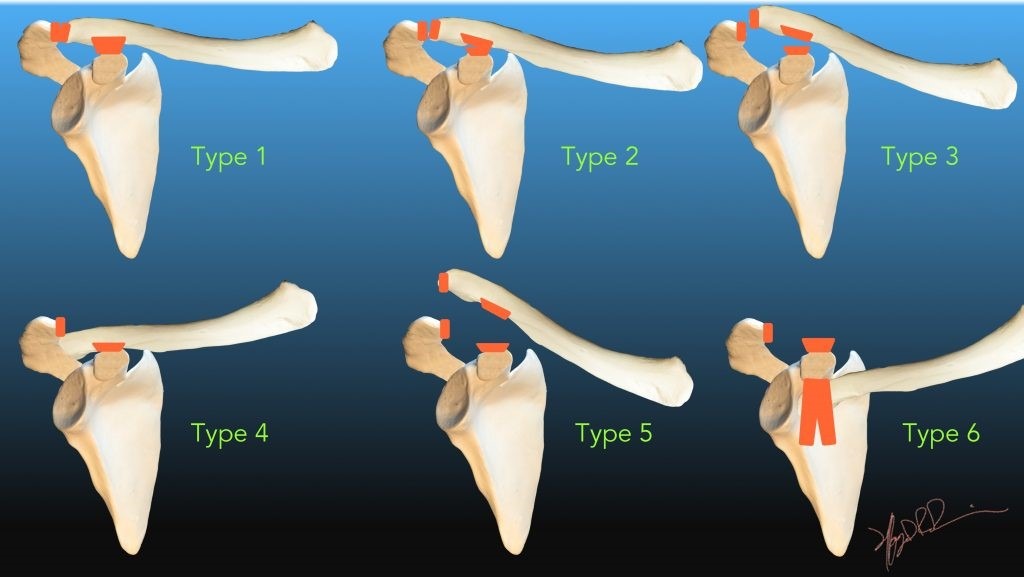 Rockwood classification of AC Joint Separation