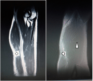 X Ray showing Bankart Lesion