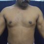 Partial rupture through the short head of the biceps muscle belly