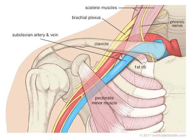 thoracic-outlet-syndrome
