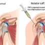 Arthroscopic Surgery for Rotator Cuff Repair