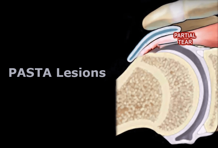 PASTA-lesions-of-the-Shoulder