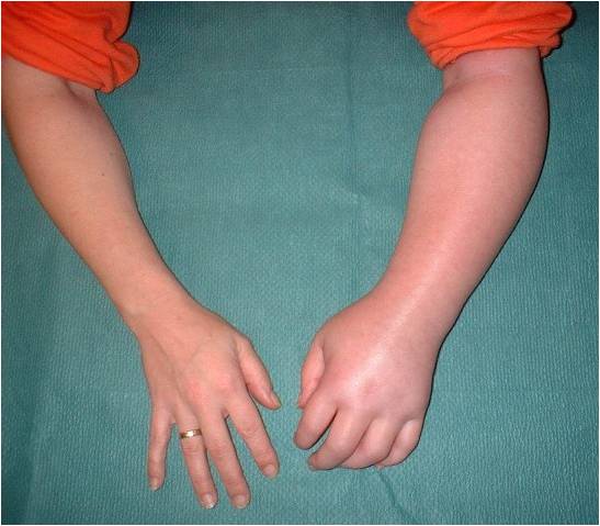 Shoulder-Hand Syndrome
