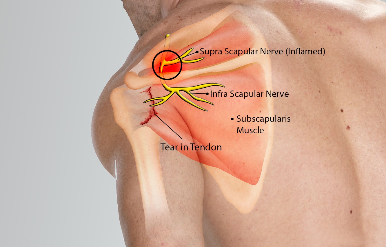 dorsal scapular nerve entrapment