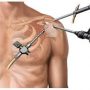 Types of Shoulder Surgery