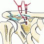 Arthroscopic Coracoclavicular Ligament Reconstruction