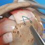 Shoulder Arthroscopy For Rotator Cuff Tears