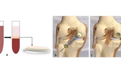 Bone Marrow Aspirate Technique of Cartilage Repair