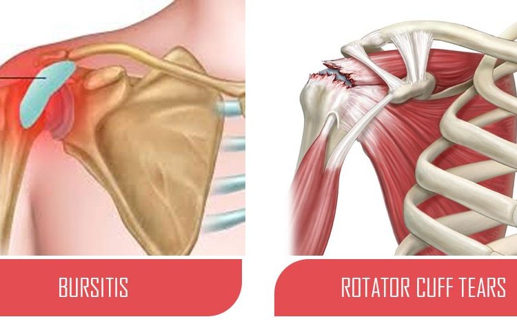 Rotator Cuff Tear Versus Bursitis, Treatment