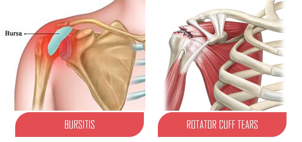 Rotator Cuff Tear Versus Bursitis, Treatment