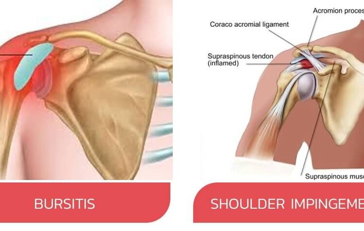 Arthritis and AC Joint Dislocation Surgeries in Bangalore - Dr