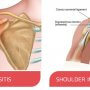 Shoulder bursitis and shoulder impingement