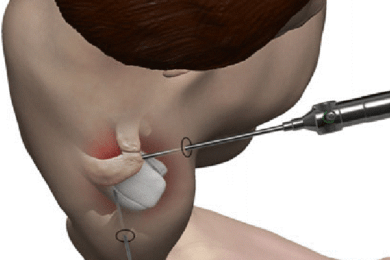 Arthroscopic posterior capsulolabral repair