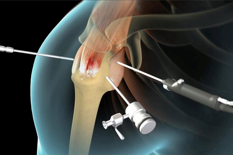 Different kinds of rotator cuff surgery