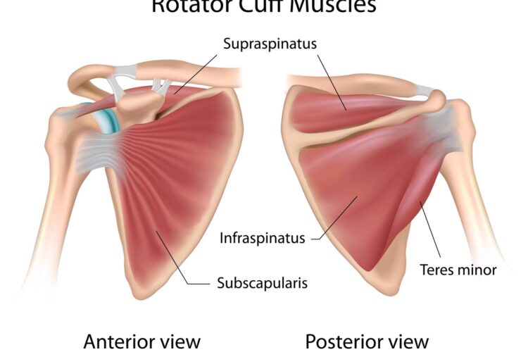 What Are Supraspinatus and Subscapularis Tendinosis